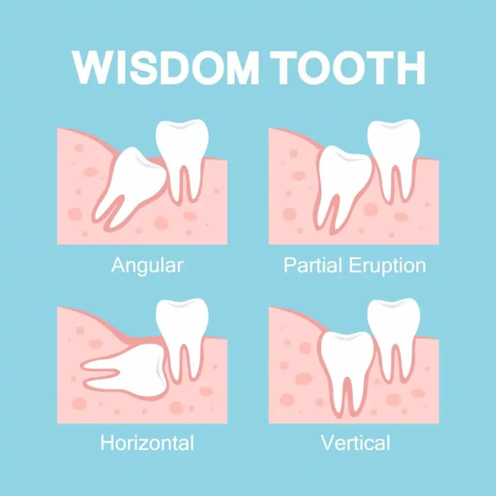 wisdom-teeth-removal-cost-breakdown-teeth-wisdom