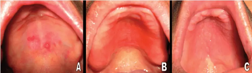 stomatitis